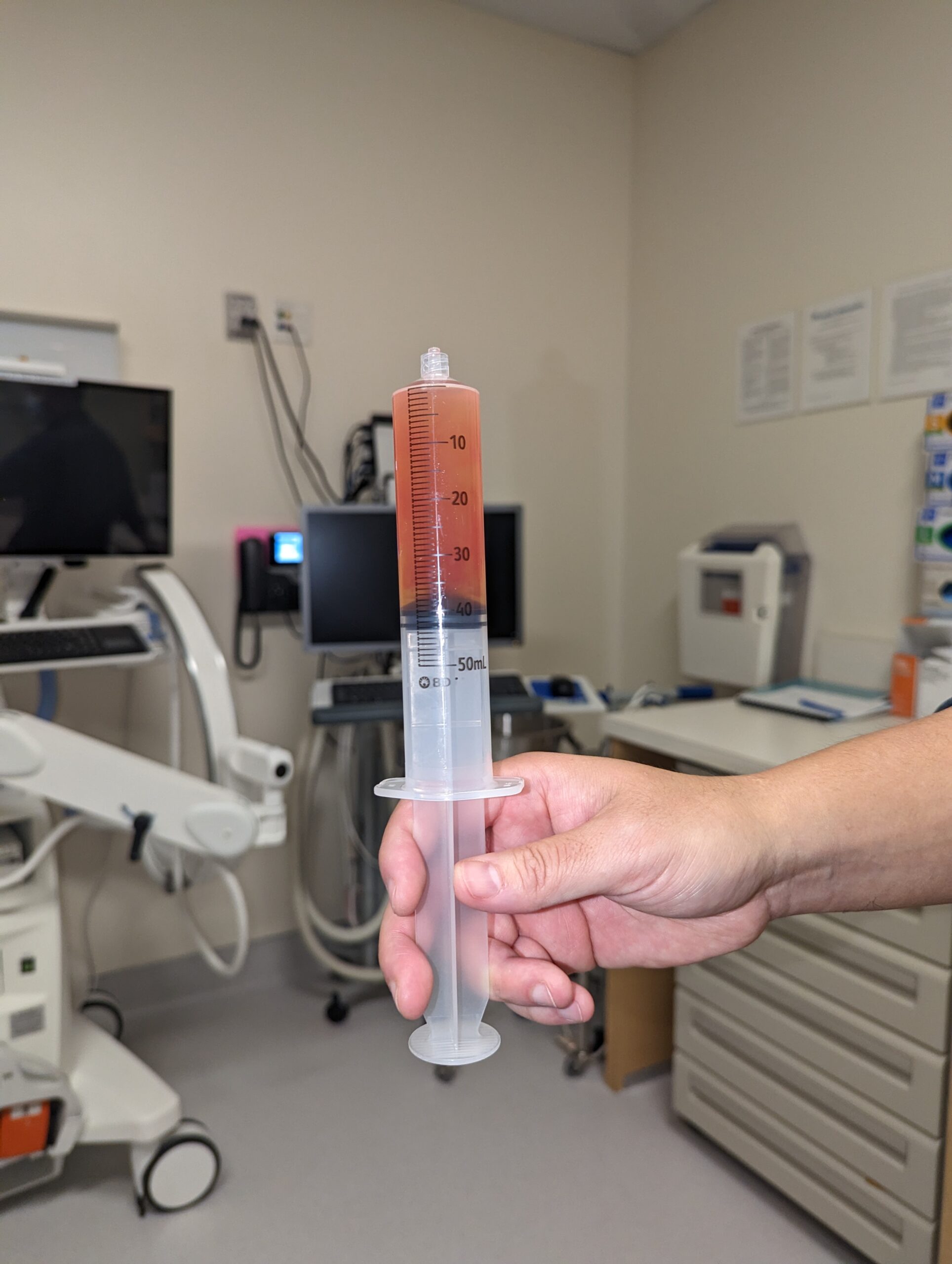 Syringe nearly full of synovial fluid aspirated from the knee