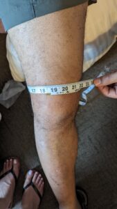 Knee swelling with Synovial fluid to 18.5" when it is normally 16.5"